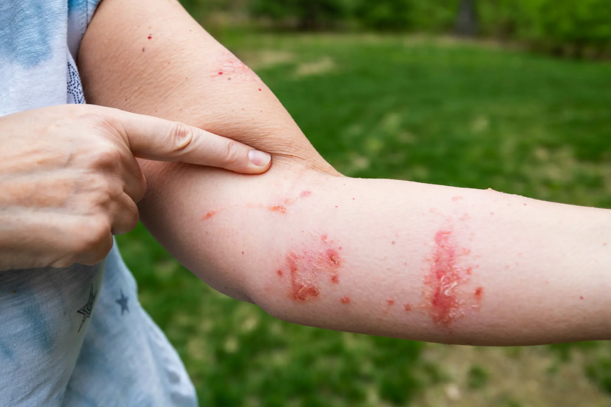 Person With Poison Ivy contact